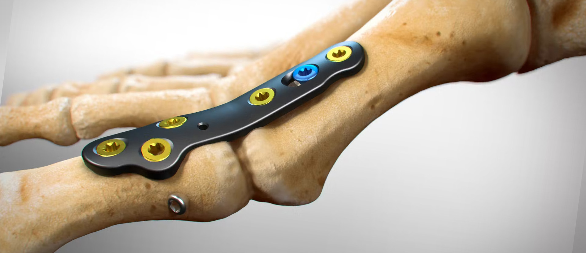 Utilizing PEEK-OPTIMA®